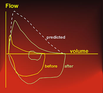 Maximum expiratory flow-volume curve in reversible airway obstruction