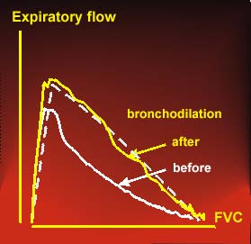 Flow-volume curve prior to and post bronchodilator drug in severe asthma