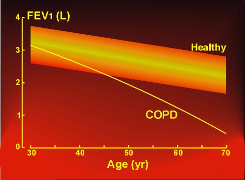 Development of FEV1 in COPD