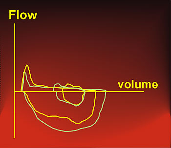 Tidal and maximum expiratory flow-volume curve in very severe airway obstruction 