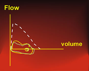Flow-volume curve in inspiratory flow limitation