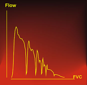 Flow-volume curve distorted by coughing