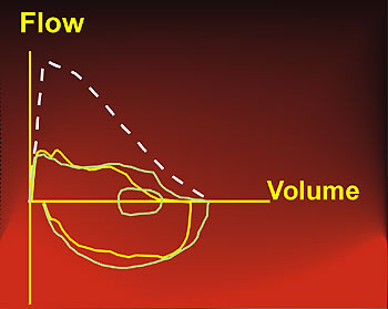 Flow-volume curve and fixed extensive intrathoracic airway obstruction
