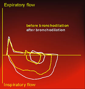 Flow-volume curve prior to and after bronchodilator drug