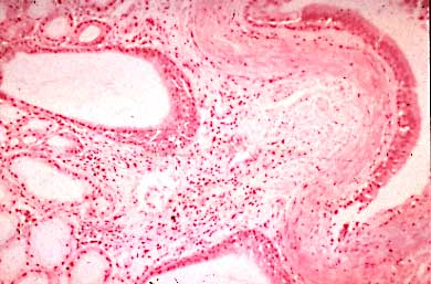 Smooth muscle hypertrophy and thickened basal membrane in a woman dying of asthma
