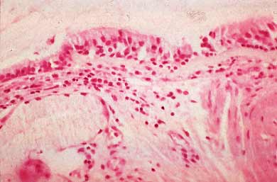 Note thick basal membrane under the epithelial layer, which is covered with much mucus in fatal case of status asthmaticus.